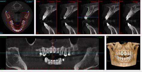 cbct vs ct|cbct scan dental code.